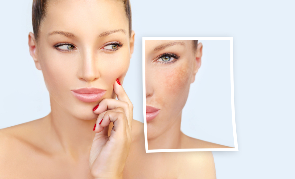 MELASMA