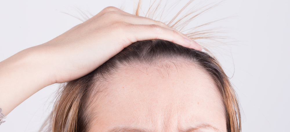 ALOPECIA FRONTAL FIBROSANTE